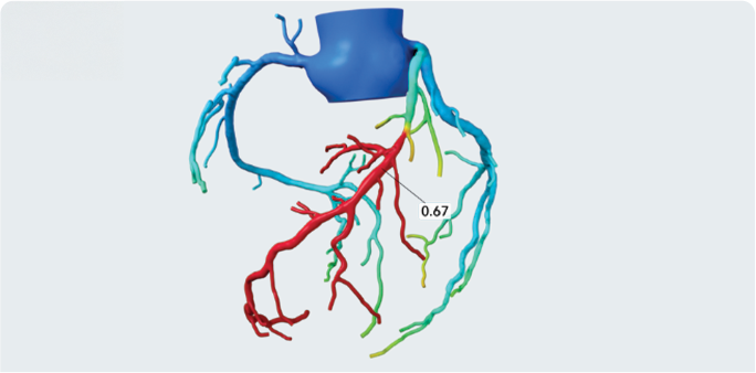 CT HEART WITH HEARTFLOW