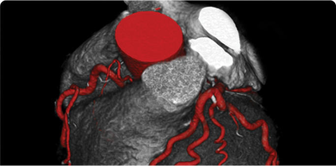 CT HEART